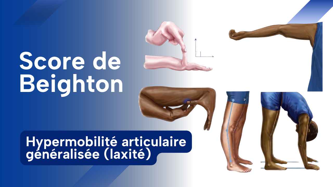 Vignette du score de Beighton évaluant l'hypermobilité articulaire